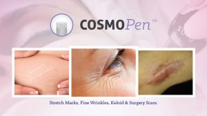 COSMOPen Microneedling Skin Treatment