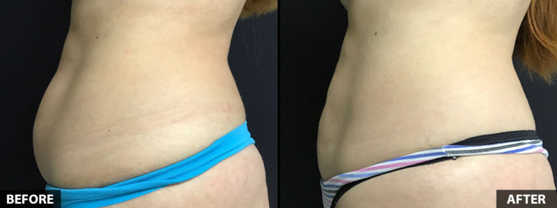 abdominal-liposuction-50yo-female-4mo-postop