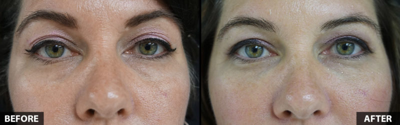 restlyane-lower-eyelid-resurfacing
