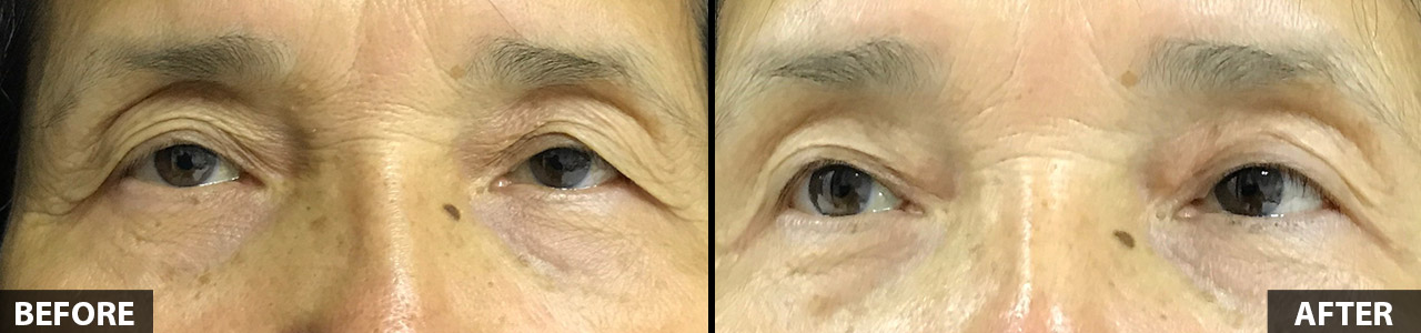 upper-eyelid-surgery-66-yo-female-2020