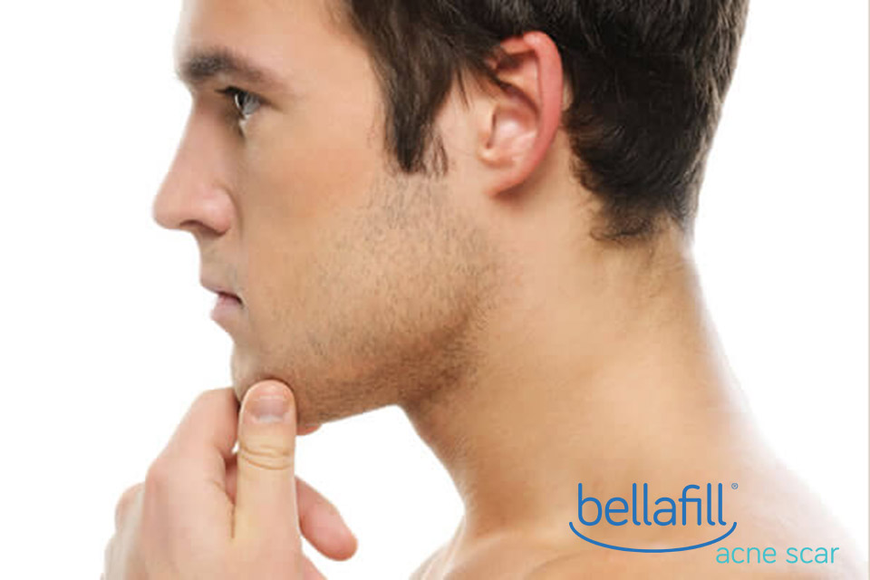 Bellafill Acne Scar Removal Injectables