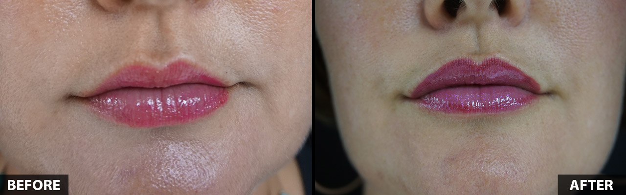 restlyane-lips-before-after-1