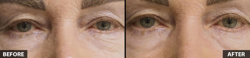 restylane-before-and-after-63yo-female