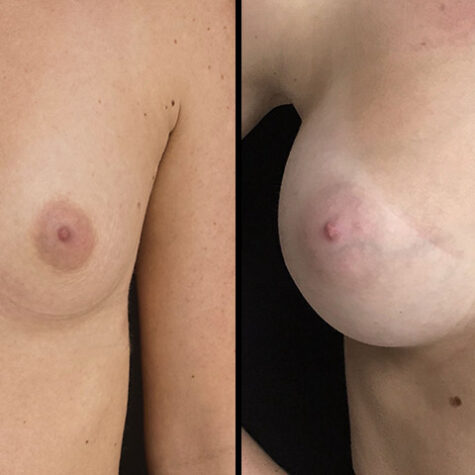 breast-augmentation-25yo-front