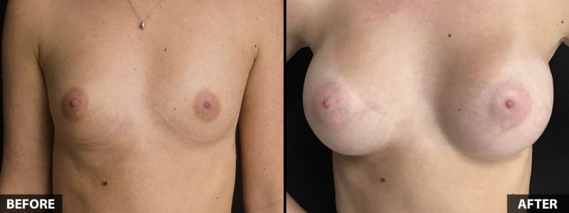 breast-augmentation-25yo-front