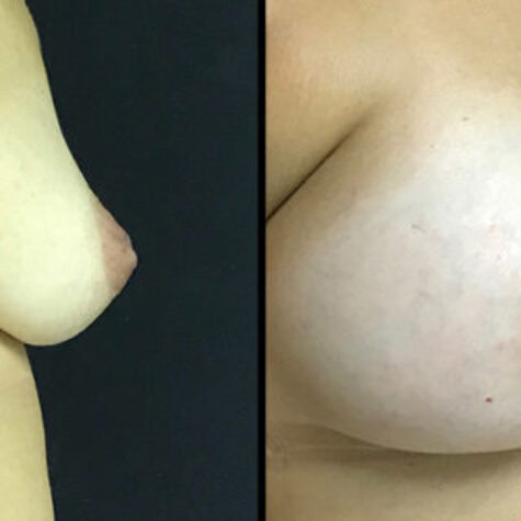 39yo-breast-augmentation-nipple-repair-right-1024x320