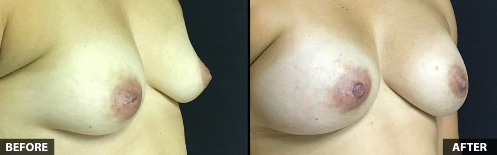 39yo-breast-augmentation-nipple-repair-right-1024x320